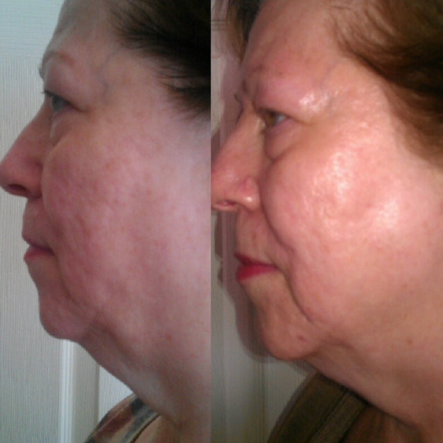 Real user experience with Anti-aging face toning device for visible facial lift
