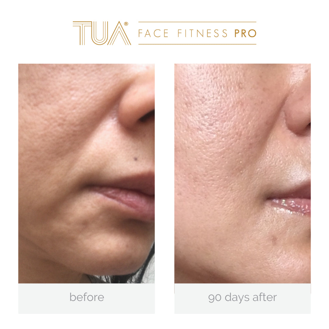 Visible facial toning results using Anti-Aging EMS Beauty Device for natural facelift