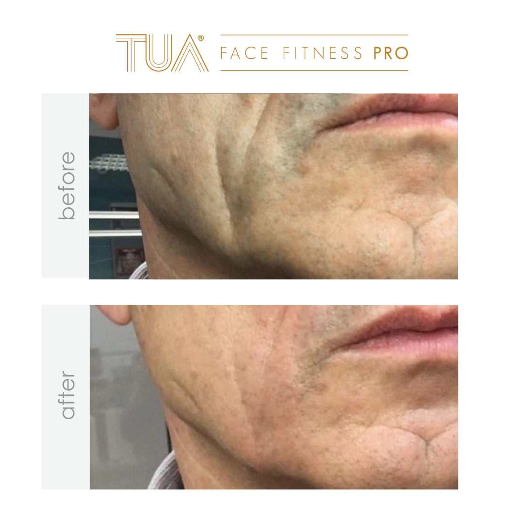 Showcasing of immediate result of using the best skincare device from TUA